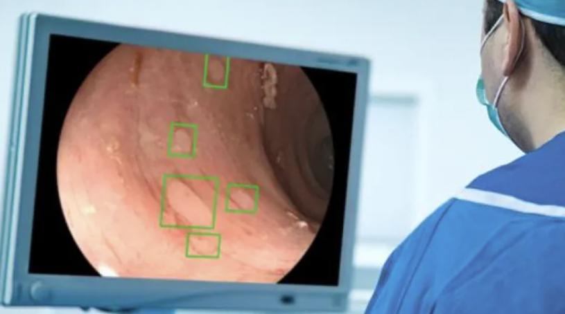GI Genius使用人工智能系统扫描结肠镜检查的图像，能更有效发现癌前息肉。(Medtronic)