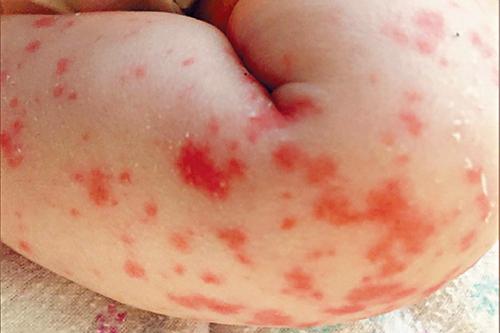 女婴下肢出现红疹。   
加拿大医学协会期刊
