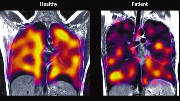 左邊為健康的肺，右邊病人肺的大片黑色代表肺部異常。