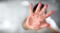 衛生局：烈治文山市民有可能感染麻疹