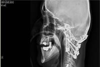 全球首宗移植3D打印脊骨手术