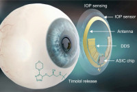 科技生活| 感應隱形眼鏡針對青光眼  根據眼壓自動調節放藥量