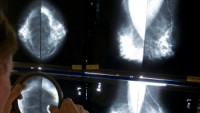 安省乳腺癌筛查降至40岁 额外增加13万次检查