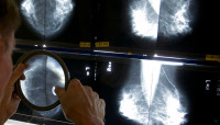 加拿大癌症协会建议  各省应允许逾40岁妇女定期做乳癌筛检
