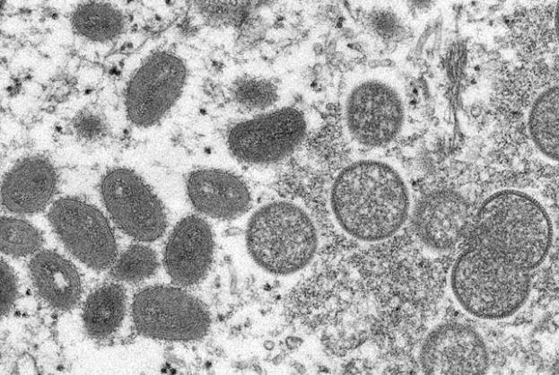 這張由疾病控制和預防中心提供的 2003 年電子顯微鏡圖像顯示，成熟的橢圓形猴痘病毒粒子（左側）和球形未成熟病毒粒子（右側），這些病毒粒子是從與 2003 年土撥鼠疫情相關的人體皮膚樣本中獲得。美聯社