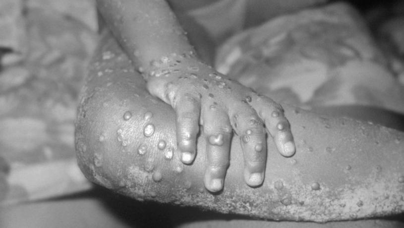 猴痘症徵狀。美國疾病控制及預防中心網頁
