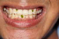 牙齒健康｜牙縫卡菜渣=患牙周病？攝牙罅恐藏4大問題須杜牙根