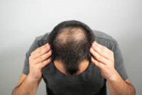 癌症症狀｜禿頭男患前列腺癌風險高？研究揭男性出現3大特徵恐患癌