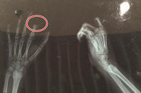 蘇州男童玩手機被罵　拿菜刀自斬兩節手指