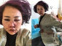 遊麗江遭暴打「爆樽」毀容　女子報警被留難