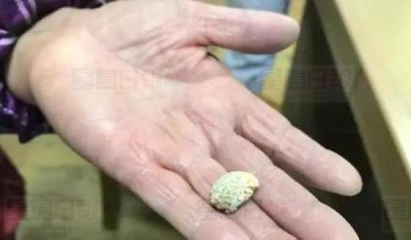 扁桃腺也会生结石 浙妇长期喉咙痛竟咳出 石头 扁桃腺也会生结石 浙妇长期喉咙痛竟咳出 石头