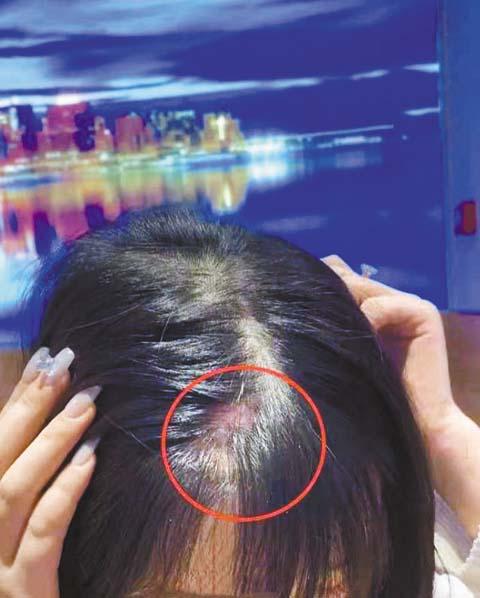 網傳有人使用後頭髮現
禿斑。 網上圖片
