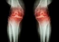 骨關節炎疼痛治療新出路  截斷「分子通路」正常郁動