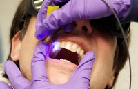 光学检测知牙菌膜酸度  预测蛀牙及时防止变坏