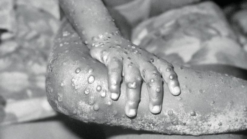 ■染上猴痘症出现的征状。美国疾控中心网页