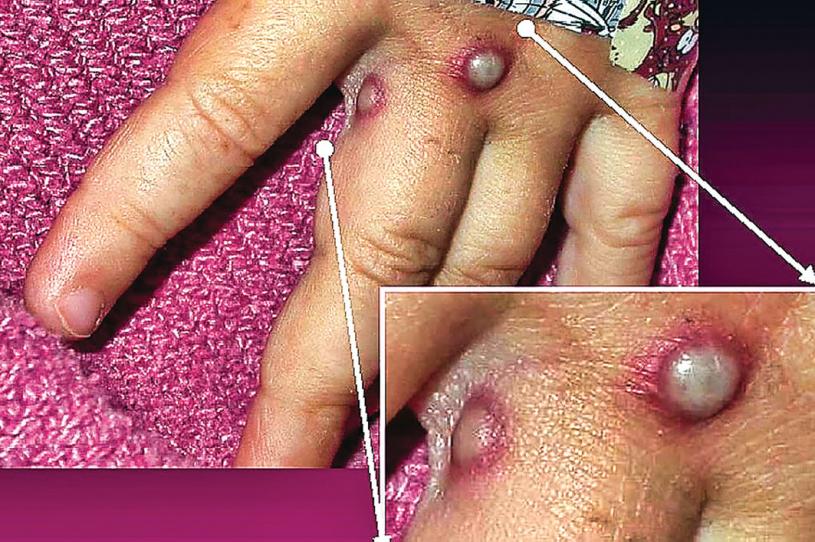 ■感染猴痘症患者皮膚出現異狀。星報資料圖片