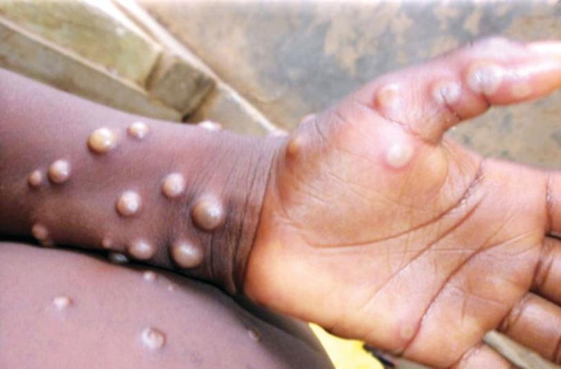 ■感染猴痘的早期征状，包括发烧、肌肉酸痛及疲劳；严重会出现类似水痘及天花的皮疹。 资料图片