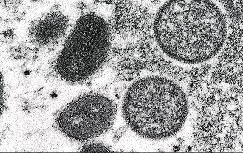 ■截至上月底，安省有77宗猴痘確診，患者全為男性。圖為顯微鏡下的猴痘病毒。 資料圖片