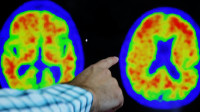 衰退速度可減緩35% 禮來阿茲海默症新藥將速送審