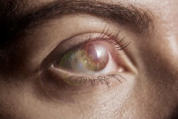 科技生活| 眼球植入太陽能板自供電  仿生技術救嚴重眼疾患者
